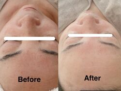 【フェイシャルクレイテラピー】Before➡︎ After