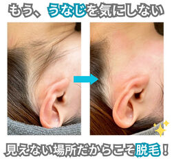 うなじ脱毛体験しませんか？