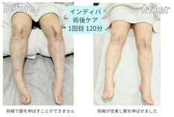 美容医療の術前後ケアもインディバで叶う！